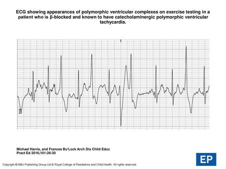 ECG showing appearances of polymorphic ventricular complexes on exercise testing in a patient who is β-blocked and known to have catecholaminergic polymorphic.