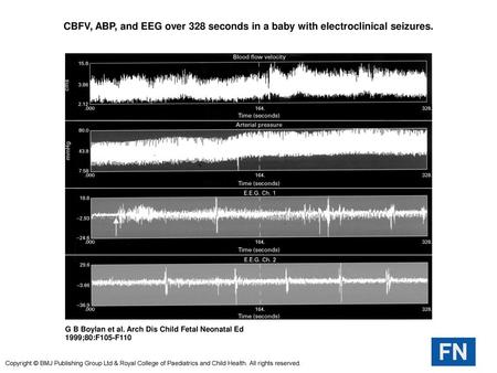 CBFV, ABP, and EEG over 328 seconds in a baby with electroclinical seizures. CBFV, ABP, and EEG over 328 seconds in a baby with electroclinical seizures.