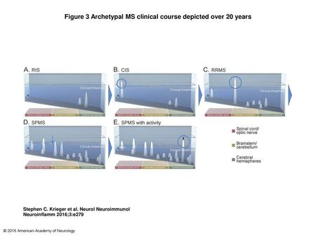 Figure 3 Archetypal MS clinical course depicted over 20 years