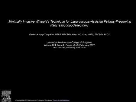 Minimally Invasive Whipple's Technique for Laparoscopic-Assisted Pylorus-Preserving Pancreaticoduodenectomy  Frederick Hong-Xiang Koh, MBBS, MRCSEd, Alfred.