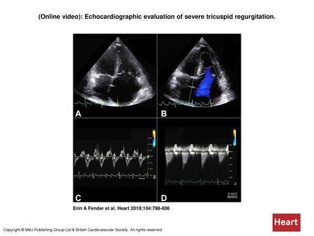 (Online video): Echocardiographic evaluation of severe tricuspid regurgitation. (Online video): Echocardiographic evaluation of severe tricuspid regurgitation.