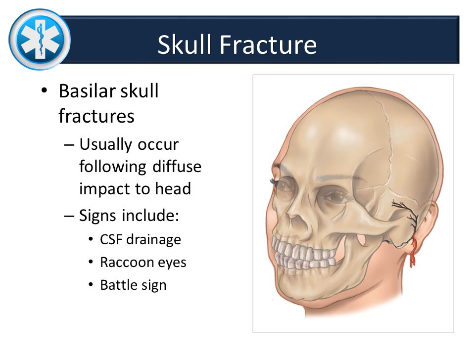 Skull+Fracture+Basilar+skull+fractures