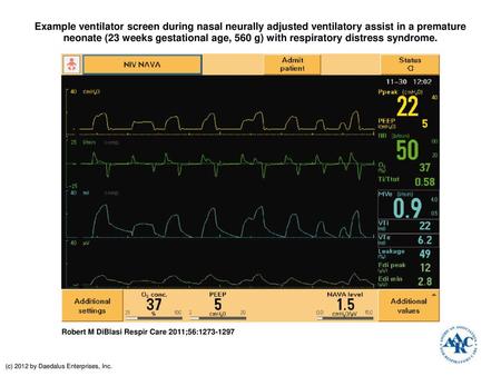 Example ventilator screen during nasal neurally adjusted ventilatory assist in a premature neonate (23 weeks gestational age, 560 g) with respiratory distress.
