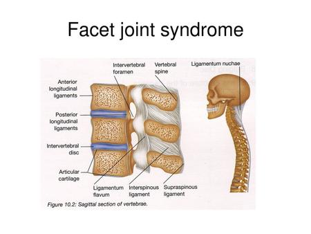 Facet joint syndrome.