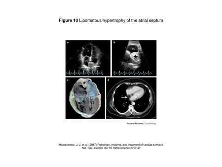 Figure 10 Lipomatous hypertrophy of the atrial septum