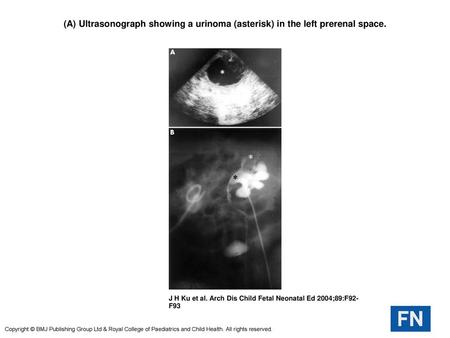 (A) Ultrasonograph showing a urinoma (asterisk) in the left prerenal space. (A) Ultrasonograph showing a urinoma (asterisk) in the left prerenal space.