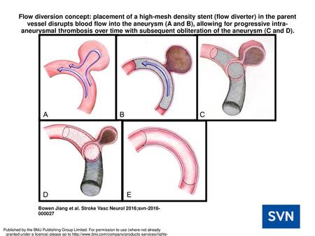 Flow diversion concept: placement of a high-mesh density stent (flow diverter) in the parent vessel disrupts blood flow into the aneurysm (A and B), allowing.