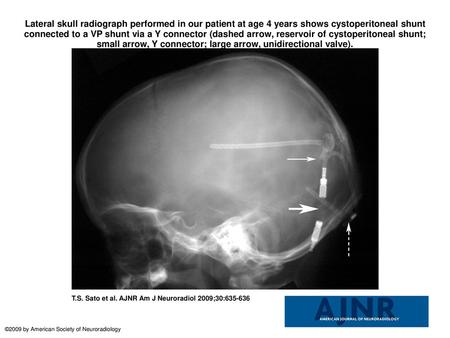 Lateral skull radiograph performed in our patient at age 4 years shows cystoperitoneal shunt connected to a VP shunt via a Y connector (dashed arrow, reservoir.