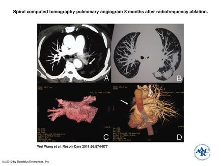 Spiral computed tomography pulmonary angiogram 8 months after radiofrequency ablation. Spiral computed tomography pulmonary angiogram 8 months after radiofrequency.