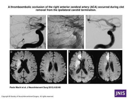 A thromboembolic occlusion of the right anterior cerebral artery (ACA) occurred during clot removal from the ipsilateral carotid termination. A thromboembolic.