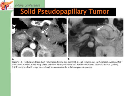 Solid Pseudopapillary Tumor