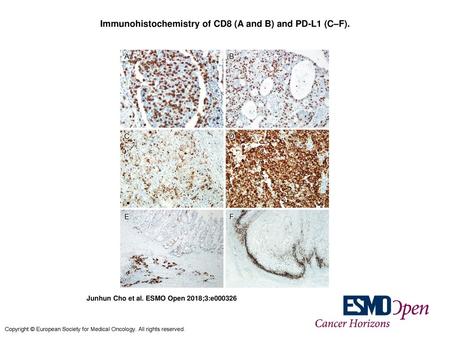 Immunohistochemistry of CD8 (A and B) and PD-L1 (C–F).