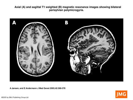  Axial (A) and sagittal T1 weighted (B) magnetic resonance images showing bilateral perisylvian polymicrogyria.  Axial (A) and sagittal T1 weighted (B)