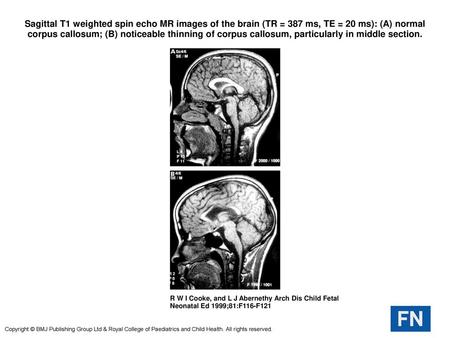 Sagittal T1 weighted spin echo MR images of the brain (TR = 387 ms, TE = 20 ms): (A) normal corpus callosum; (B) noticeable thinning of corpus callosum,