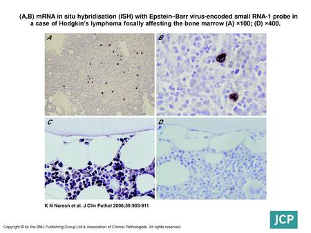  (A,B) mRNA in situ hybridisation (ISH) with Epstein–Barr virus-encoded small RNA-1 probe in a case of Hodgkin’s lymphoma focally affecting the bone marrow.
