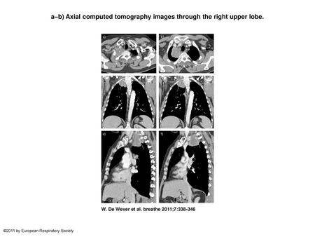 a–b) Axial computed tomography images through the right upper lobe.