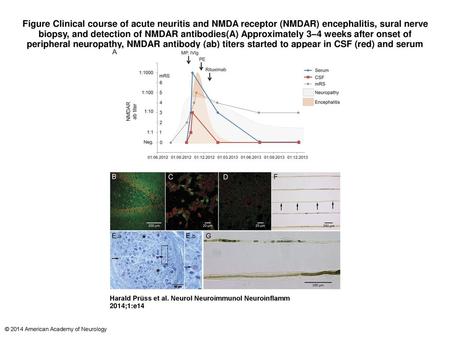 Figure Clinical course of acute neuritis and NMDA receptor (NMDAR) encephalitis, sural nerve biopsy, and detection of NMDAR antibodies(A) Approximately.