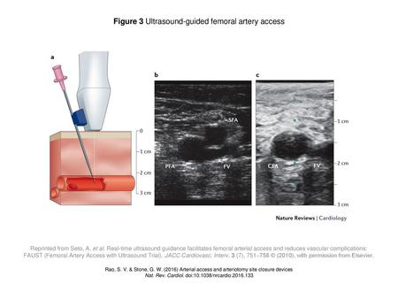 Figure 3 Ultrasound-guided femoral artery access