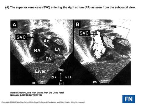 (A) The superior vena cava (SVC) entering the right atrium (RA) as seen from the subcostal view. (A) The superior vena cava (SVC) entering the right atrium.