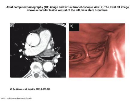 Axial computed tomography (CT) image and virtual bronchoscopic view