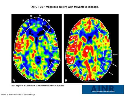 Xe-CT CBF maps in a patient with Moyamoya disease.