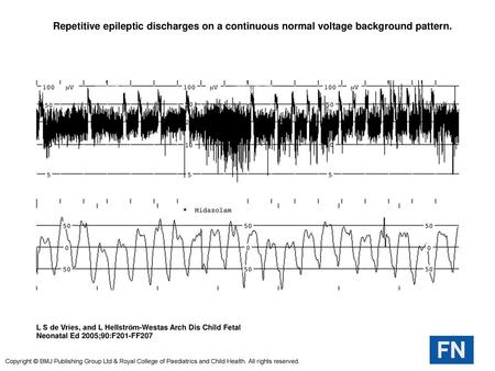  Repetitive epileptic discharges on a continuous normal voltage background pattern.  Repetitive epileptic discharges on a continuous normal voltage background.