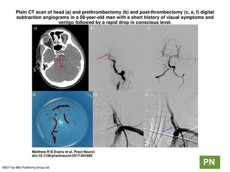 Plain CT scan of head (a) and prethrombectomy (b) and post-thrombectomy (c, e, f) digital subtraction angiograms in a 58-year-old man with a short history.