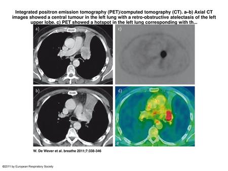 Integrated positron emission tomography (PET)/computed tomography (CT)