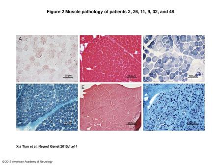 Figure 2 Muscle pathology of patients 2, 26, 11, 9, 32, and 48