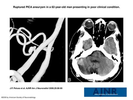 Ruptured PICA aneurysm in a 62-year-old man presenting in poor clinical condition. Ruptured PICA aneurysm in a 62-year-old man presenting in poor clinical.