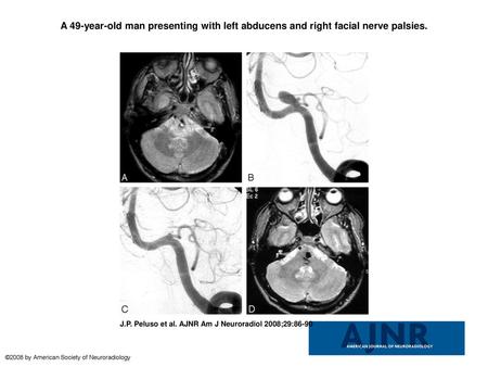 A 49-year-old man presenting with left abducens and right facial nerve palsies. A 49-year-old man presenting with left abducens and right facial nerve.