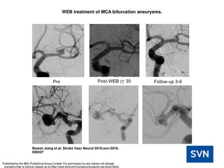WEB treatment of MCA bifurcation aneurysms.