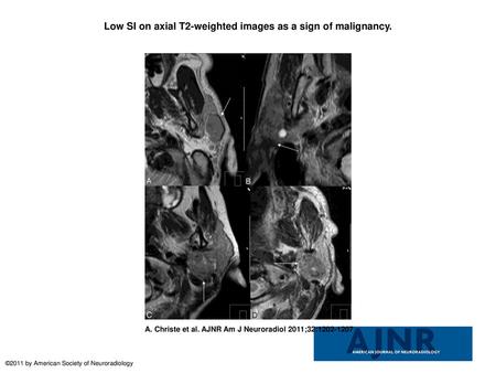 Low SI on axial T2-weighted images as a sign of malignancy.