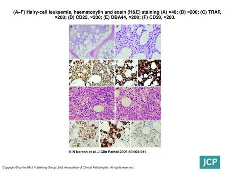  (A–F) Hairy-cell leukaemia, haematoxylin and eosin (H&E) staining (A) ×40; (B) ×200; (C) TRAP, ×200; (D) CD25, ×200; (E) DBA44, ×200; (F) CD20, ×200.