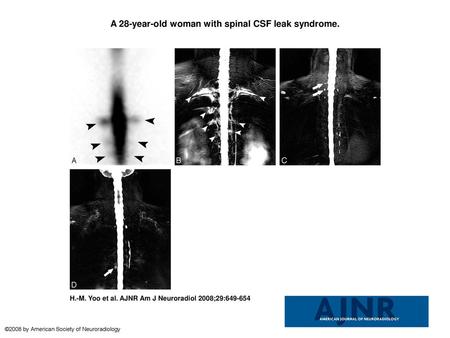 A 28-year-old woman with spinal CSF leak syndrome.