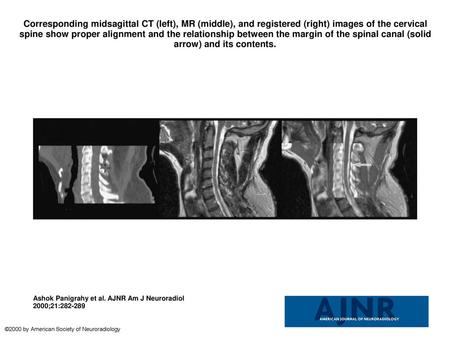 Corresponding midsagittal CT (left), MR (middle), and registered (right) images of the cervical spine show proper alignment and the relationship between.