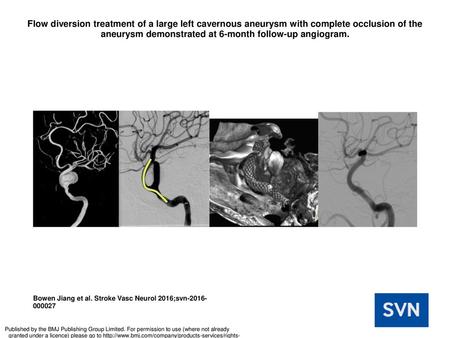 Flow diversion treatment of a large left cavernous aneurysm with complete occlusion of the aneurysm demonstrated at 6-month follow-up angiogram. Flow diversion.