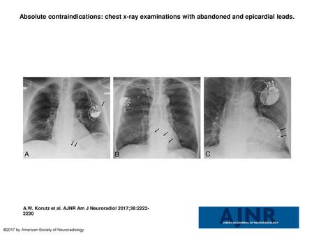 Absolute contraindications: chest x-ray examinations with abandoned and epicardial leads. Absolute contraindications: chest x-ray examinations with abandoned.