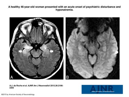 A healthy 46-year-old woman presented with an acute onset of psychiatric disturbance and hyponatremia. A healthy 46-year-old woman presented with an acute.