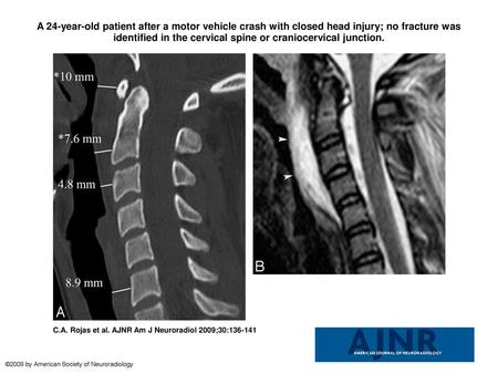 A 24-year-old patient after a motor vehicle crash with closed head injury; no fracture was identified in the cervical spine or craniocervical junction.