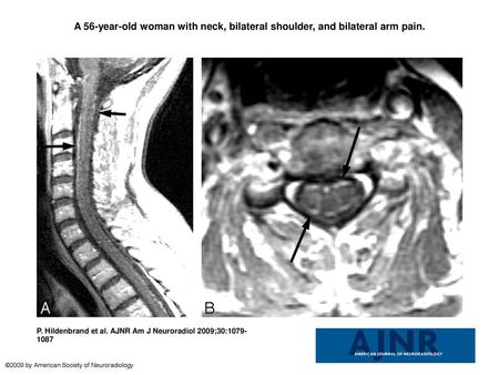 A 56-year-old woman with neck, bilateral shoulder, and bilateral arm pain. A 56-year-old woman with neck, bilateral shoulder, and bilateral arm pain. In.