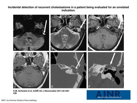 Incidental detection of recurrent cholesteatoma in a patient being evaluated for an unrelated indication. Incidental detection of recurrent cholesteatoma.