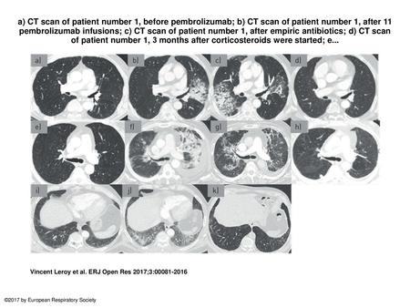 A) CT scan of patient number 1, before pembrolizumab; b) CT scan of patient number 1, after 11 pembrolizumab infusions; c) CT scan of patient number 1,