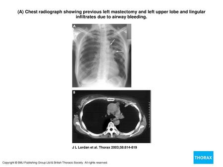 (A) Chest radiograph showing previous left mastectomy and left upper lobe and lingular infiltrates due to airway bleeding. (A) Chest radiograph showing.