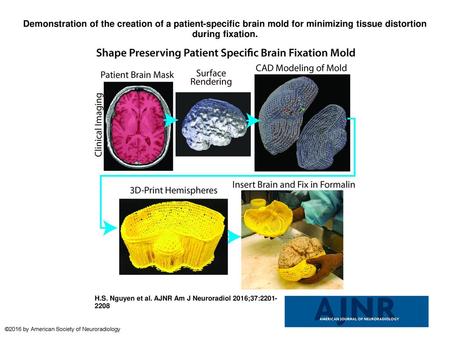 Demonstration of the creation of a patient-specific brain mold for minimizing tissue distortion during fixation. Demonstration of the creation of a patient-specific.