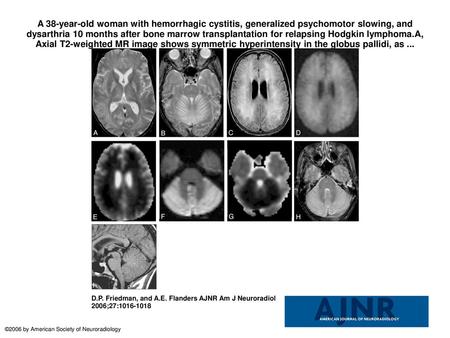 A 38-year-old woman with hemorrhagic cystitis, generalized psychomotor slowing, and dysarthria 10 months after bone marrow transplantation for relapsing.