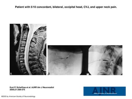 Patient with 5/10 concordant, bilateral, occipital head, CVJ, and upper neck pain. Patient with 5/10 concordant, bilateral, occipital head, CVJ, and upper.