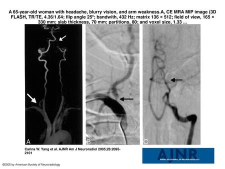 A 65-year-old woman with headache, blurry vision, and arm weakness