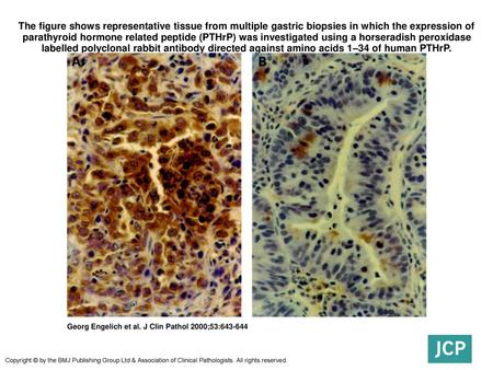 The figure shows representative tissue from multiple gastric biopsies in which the expression of parathyroid hormone related peptide (PTHrP) was investigated.