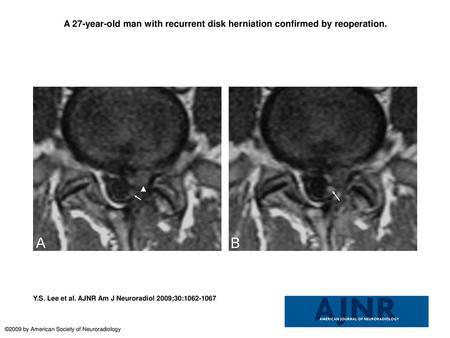 A 27-year-old man with recurrent disk herniation confirmed by reoperation. A 27-year-old man with recurrent disk herniation confirmed by reoperation. A,